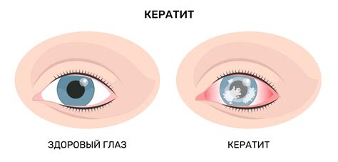 Глазные заболевания и инфекции