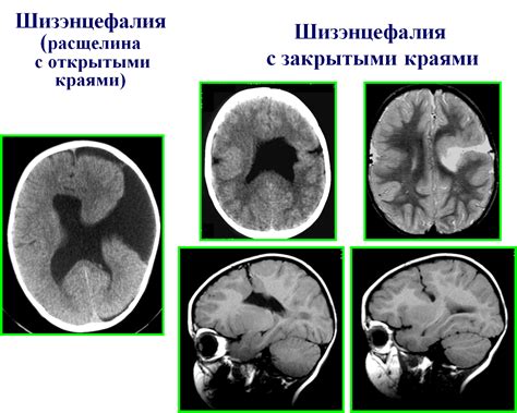 Глиоз в правой лобной доли