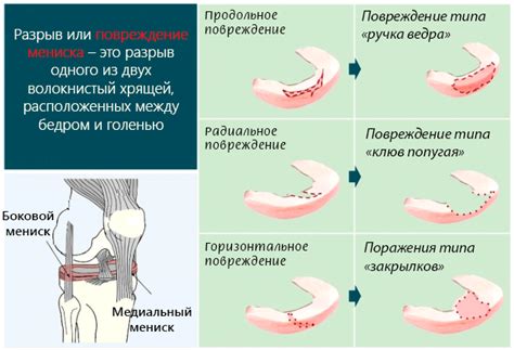 Дегенеративные изменения в суставах