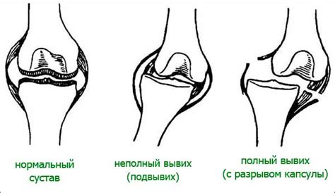 Действия при вывихе молнии