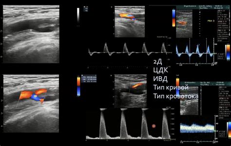 Диагностика ЦДК кровотока