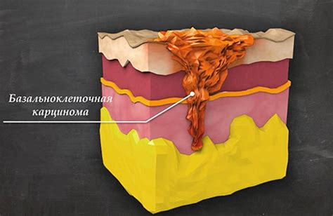 Диагностика базалиомы