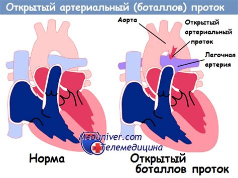 Диагностика баталов протока