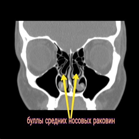 Диагностика буллы в носовой раковине