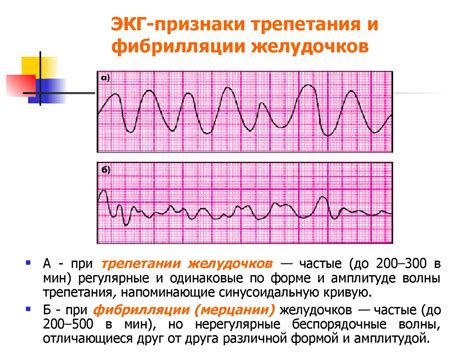 Диагностика гипертрофии миокарда на ЭКГ