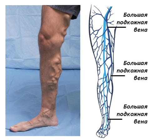 Диагностика дилатации вен