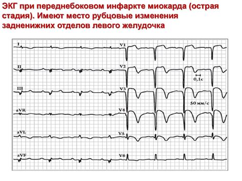 Диагностика диффузных изменений миокарда ЛЖ