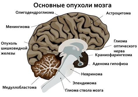 Диагностика доброкачественной опухоли головного мозга