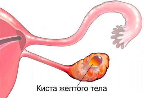 Диагностика желтого тела в яичнике