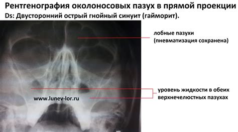 Диагностика жидкости в верхнечелюстной пазухе