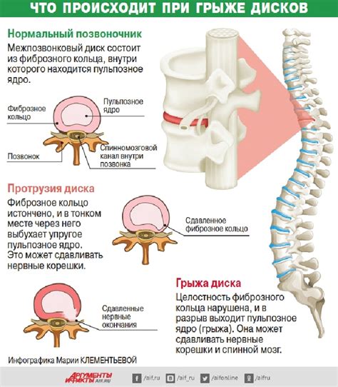 Диагностика защемления нерва в позвоночнике