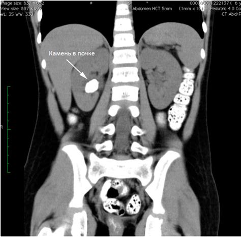 Диагностика камней в почках
