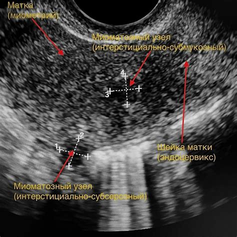 Диагностика миомы матки