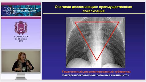 Диагностика мягкотканных очагов в легких