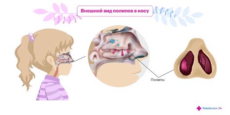 Диагностика нароста на носу