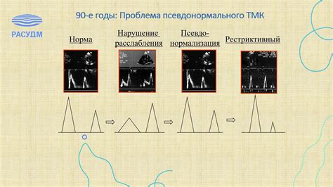 Диагностика нарушения диастолической функции 1 степени