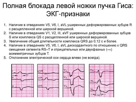 Диагностика неполной блокады ножки пучка Гиса