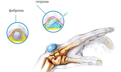 Диагностика опухоли на руке