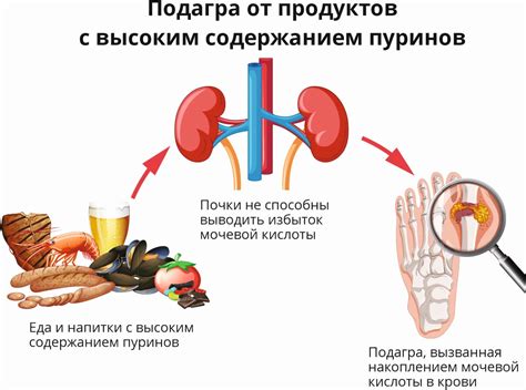 Диагностика подагры