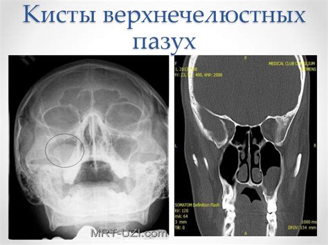 Диагностика пристеночного затемнения верхнечелюстных пазух носа