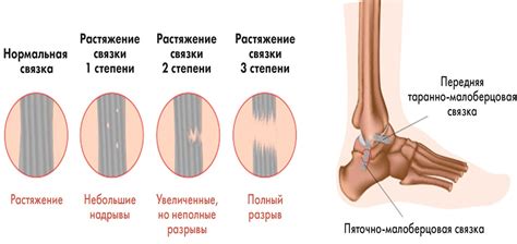 Диагностика растяжения связок на запястье