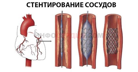 Диагностика уплотнения стенок восходящей аорты