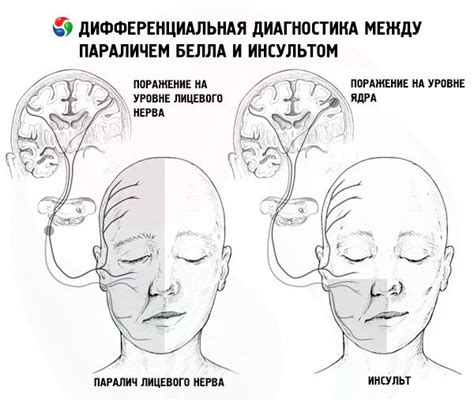 Диагностика центрального паралича лицевого нерва