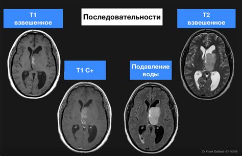 Диагностические методы в определении гипоинтенсивности на Т1