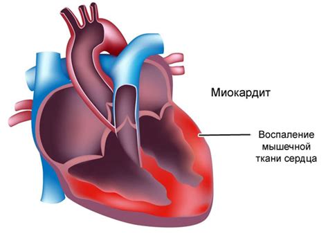 Диффузные изменения миокарда