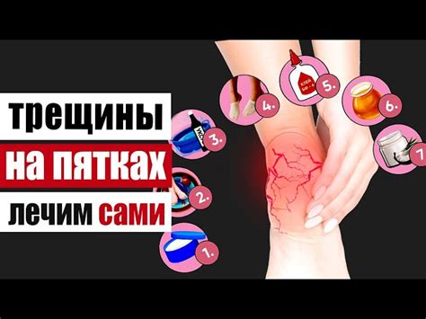 Домашние методы лечения трещины пятки