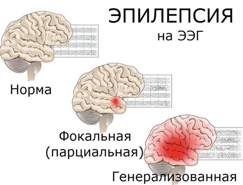 Домашние методы лечения эпилепсии