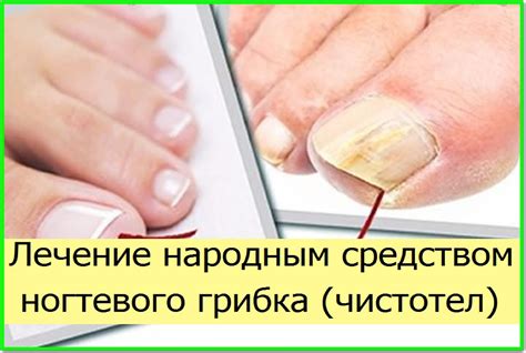 Домашние рецепты от грибка ногтей