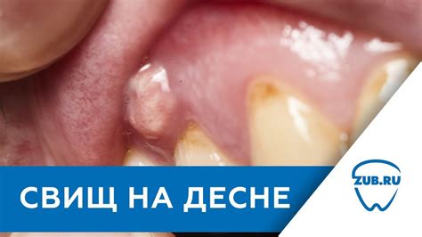 Домашние способы лечения гноя в десне