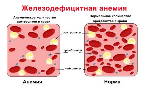 Железодефицитная анемия: возможные последствия