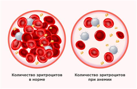 Железодефицитная анемия и концентрация гемоглобина