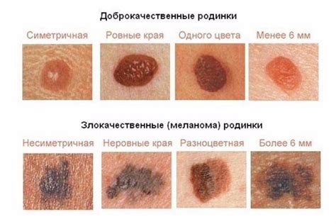 Злокачественные новообразования