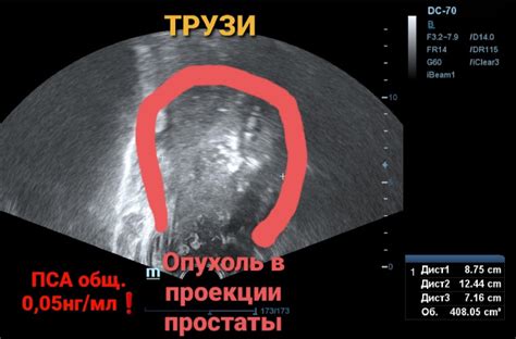 Значение и диагностика повышенного общего пса у мужчин