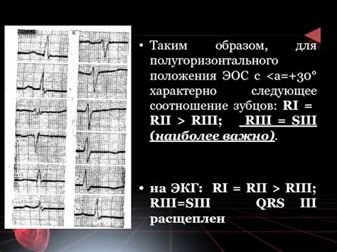 Значения полугоризонтального положения ЭОС на ЭКГ