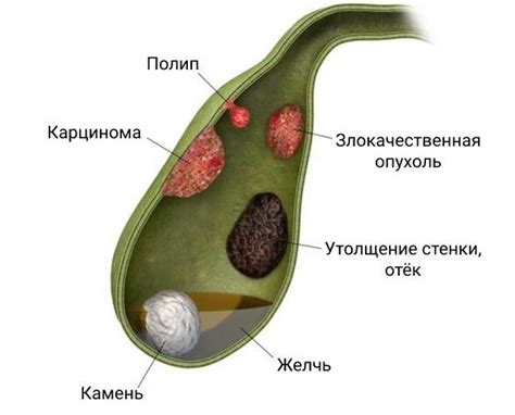 Значимость полипов желчного пузыря для пациентов