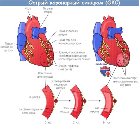 Избегайте натяжения ишемической зоны