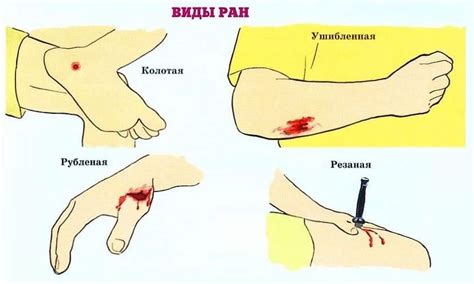 Избегайте трения и давления на рану