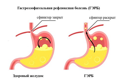 Изжога и нервозность