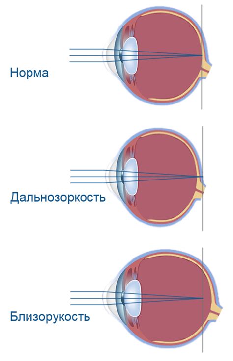 Изменение зрения: снижение качества зрения и затуманенность