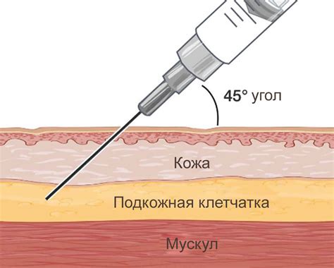 Инъекции в медицине: применение и последствия