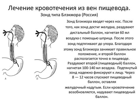 Источники кровотечения из горла