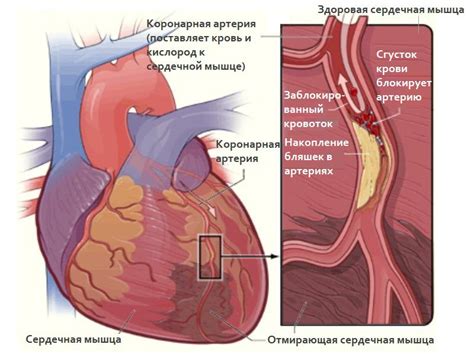 Ишемическая болезнь