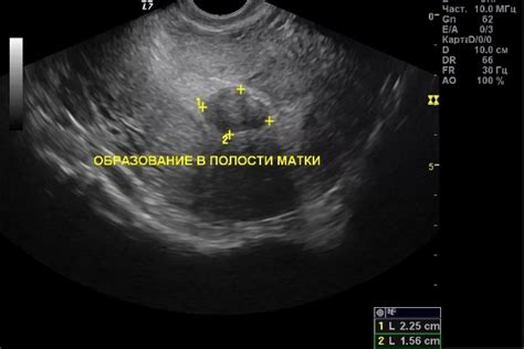 Какие значения имеет М эхо 17 мм?