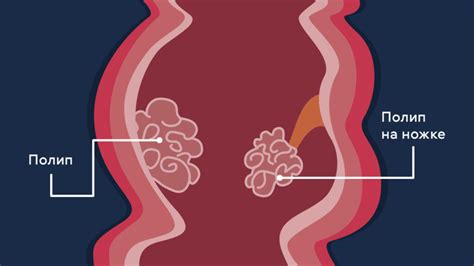 Какие методы помогут выявить злокачественный полип