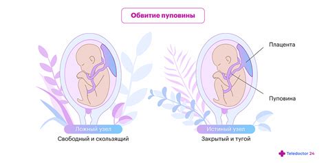 Какие могут быть последствия при обвитии пуповины вокруг шеи плода?