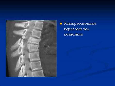 Какие профилактические меры помогают предотвратить компрессионные изменения тел позвонков